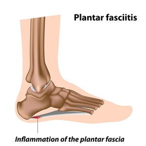 Reasons for Developing Plantar Fasciitis