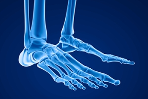 Causes of Foot Stress Fractures