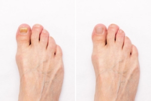 Causes of Toenail Abnormalities