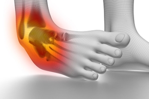 Ankle Sprains and Degrees of Injury