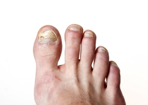 How Does Toenail Fungus Occur?