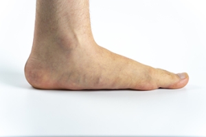 Causes and Implications of Flat Feet