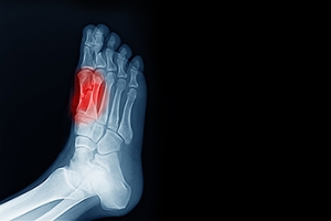 Pain Caused by Sesamoiditis