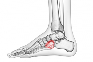 Do I Have Cuboid Syndrome?