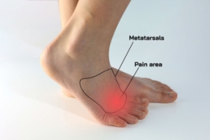 Nerve Pain in the Foot