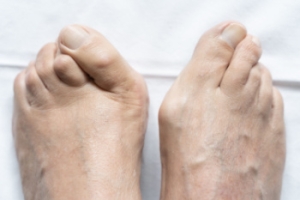 Bunions and Why They Keep Coming Back