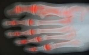 How Can I Tell if I Have Arthritic Feet?