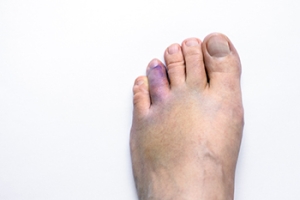 The Basics of a Broken Toe