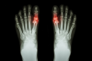 Signs and Causes of Gout