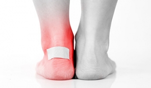 Blisters That Can Form on the Feet