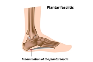 Plantar Fasciitis and Basketball