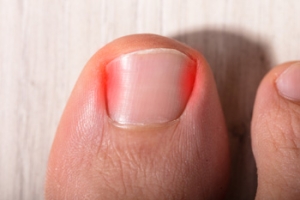 Mild Relief for Ingrown Toenails