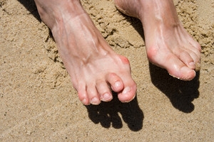 Does a Bent Toe Indicate Hammertoe?